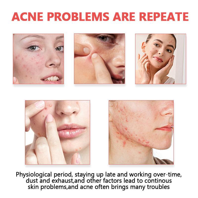 Acnepleisters Onzichtbare hydr - Skincare Oil Control recensie en prijs